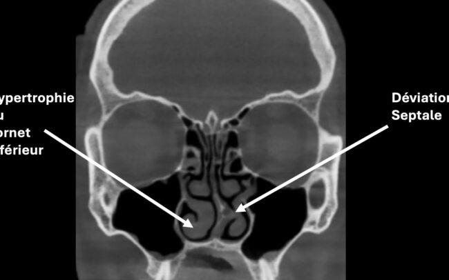 Hypertrophie des cornets